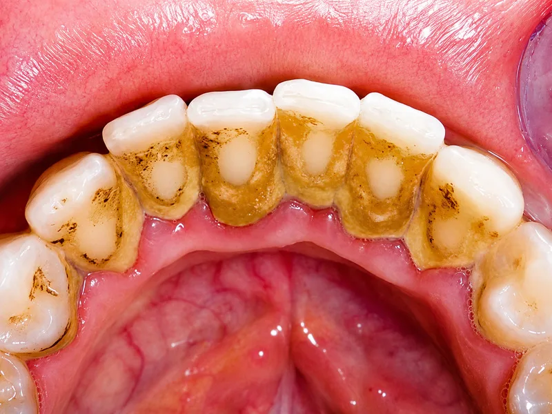 Mảng bám tích tụ quanh viền nướu là nguyên nhân chảy máu chân răng thường gặp nhất.