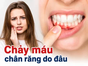 chay-mau-chan-rang-do-dau-nguyen-nhan-va-cach-xu-ly-dung