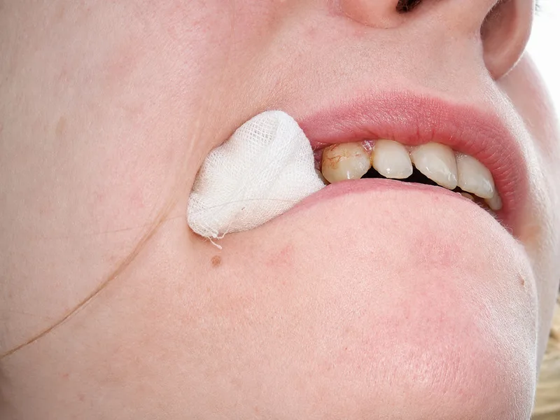 Vệ sinh nhẹ nhàng và dùng gạc sạch là cách xử lý ban đầu khi nướu xuất hiện máu.